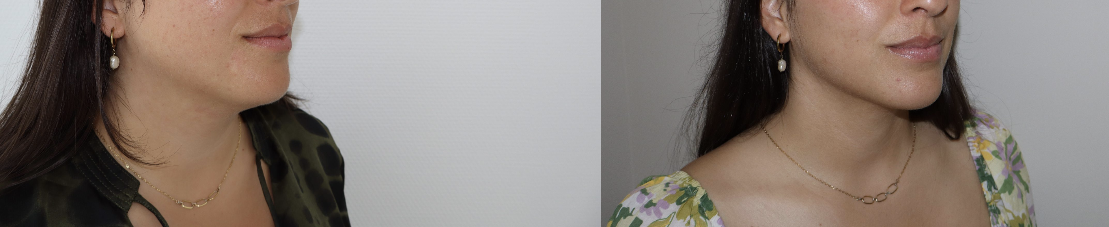 Avant/Après lipoaspiration cervicale